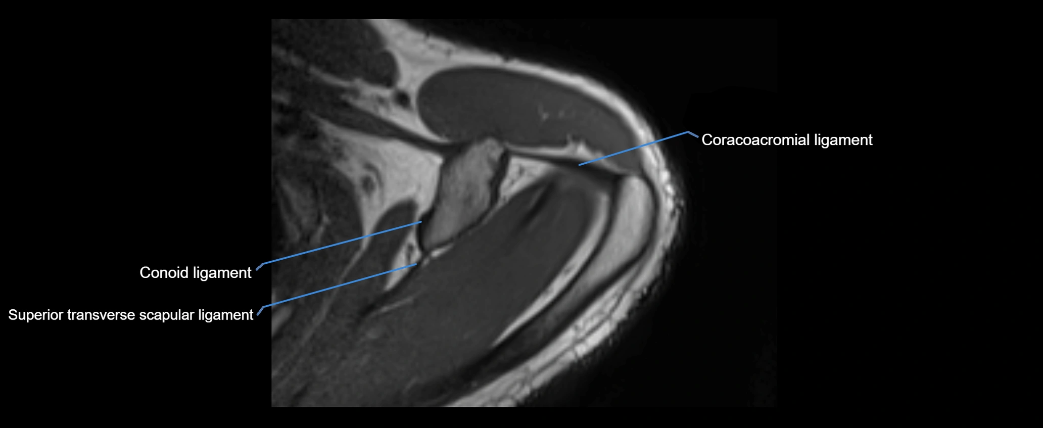 shoulder ligaments axial 3d 3t mri image-img-00005-00034.webp